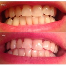 Nettoyage Blanchiment Des Dents L'hygiène Poudre Nature Charbon au meilleur prix au Maroc