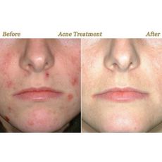 Système Pour Visage Accélère Le Renouvellement Cellulaire - 0.5mm au meilleur prix au Maroc