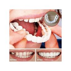 Snap on Smile parfait sourire blanchiment des dents au meilleur prix au Maroc
