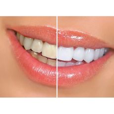 Stylo De Blanchiment Des Dents au meilleur prix au Maroc