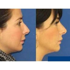 Redresseur De Nez au meilleur prix au Maroc