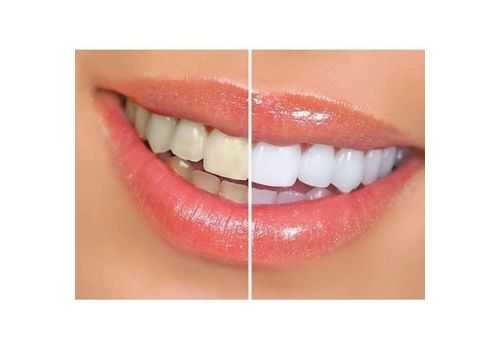 Stylo de blanchiment des dents au meilleur prix au Maroc