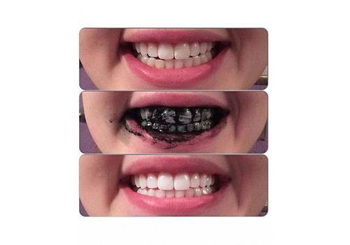 Blanchiment des dents au charbon végétal spécial blanchiment dentaire - blanchir ses dent au naturel anti-tâche au meilleur prix au Maroc