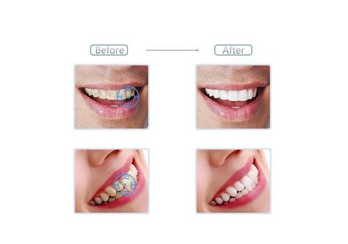 Blanchiment des dents au charbon végétal spécial blanchiment dentaire - blanchir ses dent au naturel anti-tâche au meilleur prix au Maroc