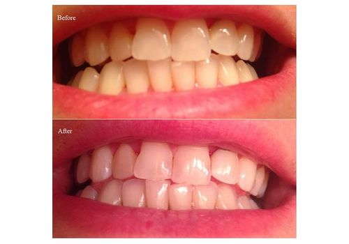 Nettoyage Blanchiment Des Dents L'hygiène Poudre Nature Charbon au meilleur prix au Maroc