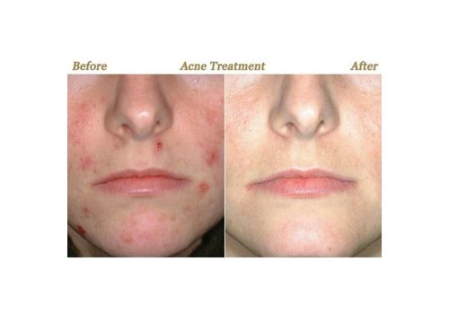 Système Pour Visage Accélère Le Renouvellement Cellulaire - 0.5mm au meilleur prix au Maroc