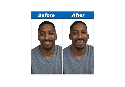 Prothèse Ajustement Flex Cosmétique Dents au meilleur prix au Maroc