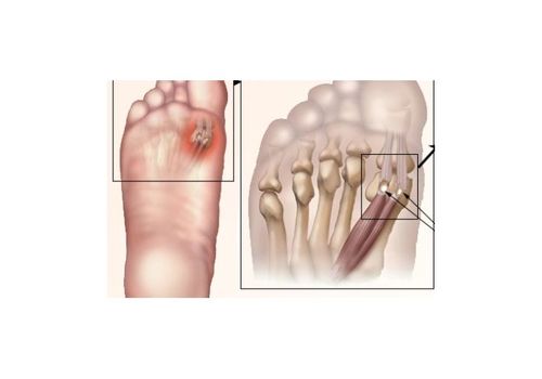 GEL MAXIMUM PADDING ELIMINATES FOREFOOT PAIN au meilleur prix au Maroc