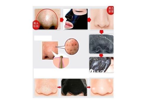 Masque Noir carbone pour éliminer l'acné et les points noirs au meilleur prix au Maroc