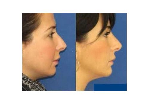 Redresseur De Nez au meilleur prix au Maroc