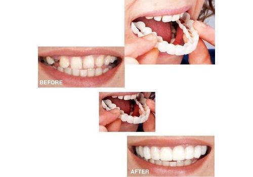 Orthodontie La Dentisterie Cosmétique Snap On Sourire Comfort Fit Flex Cosmétique au meilleur prix au Maroc